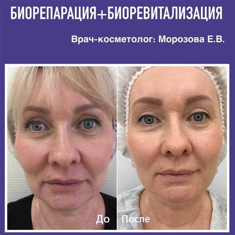 Лицо после биоревитализации на следующий день: Рекомендации после ...