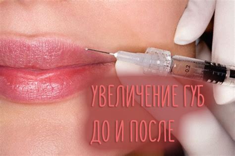 Увеличение губ гиалуроновой кислотой 1 мл * До и после с фото, что колят