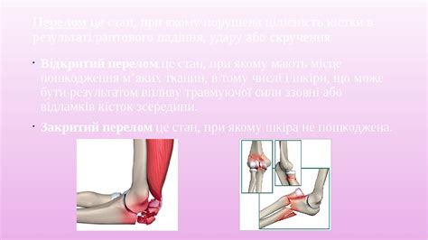 Презентація до теми "Переломи та вивихи суглобів"