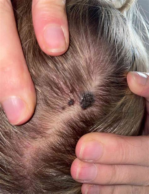 Melanoma Scalp