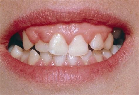 gingival hyperplasia dentistry merck manual professional edition