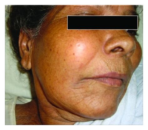 preoperative  cheek swelling  scientific diagram