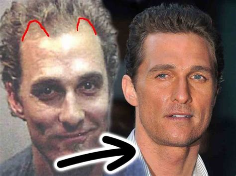 Matthew McConaughey Hair Loss Secrets Revealed!