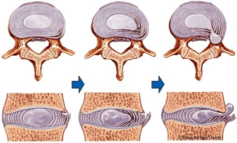 Ergodome | Hernia en discusaandoeningen
