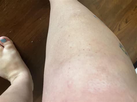What is this lump after falling? : r/medical