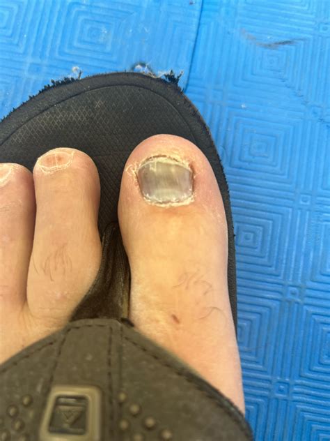 Toenail discolored and feels like it’s separating from nail bed. : r