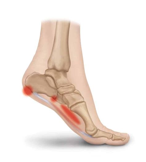 heel pain explained       foot dr