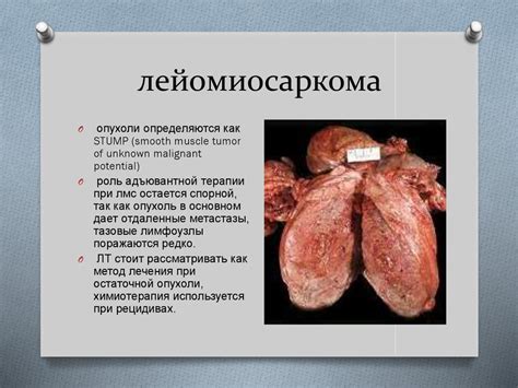 Саркома матки - презентация онлайн