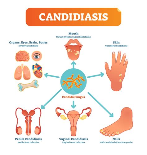 Candidiasis: causas, síntomas y consejos - Blog de Naturlíder : Blog de ...
