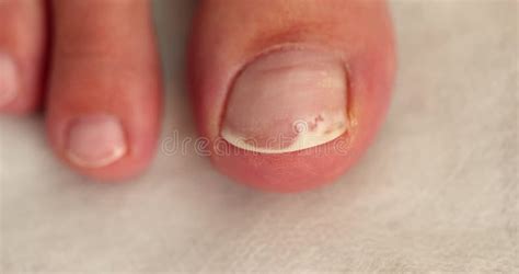 Fungal Infection on Toenail Closeup 4k Movie Slow Motion Stock Footage ...