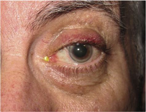 basal cell carcinoma  eyelid  raymond gillespie blog