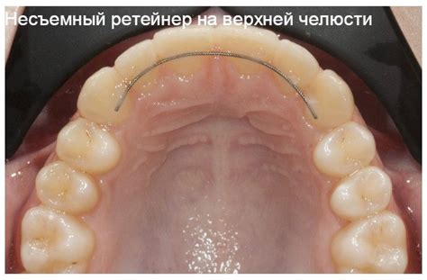 Капа ортодонтическая ретенционная. Капа при бруксизме