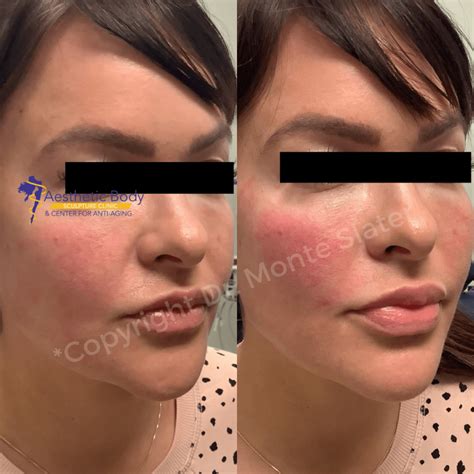 Restylane Contour now offered in Atlanta! | ABS Clinic