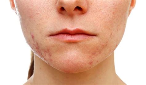 Biotin Overdose Can Cause Jawline Or Chin Rash | Justinboey