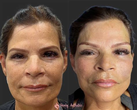 PDO Thread Lifting - Before and After Results at Skinly Aesthetics