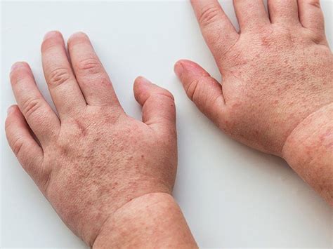 swollen joints rash fever child infoupdateorg