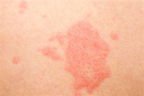 itchy spots   face printable templates protal