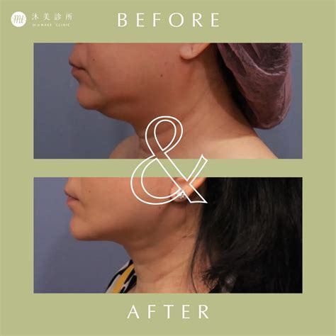 Platysmaplasty - muMAKE CLINIC | muMAKE CLINIC 沐美醫美