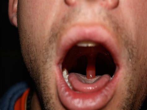 swollen uvula sore throat  treatments  remedies aimdelicious