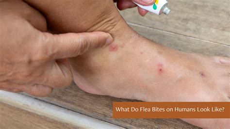 flea bites  humans easy ways  identify treat  prevent