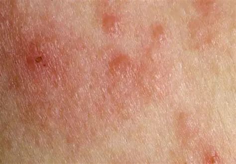 9 Common Causes Of Underarm Rash With Images Underarm - vrogue.co