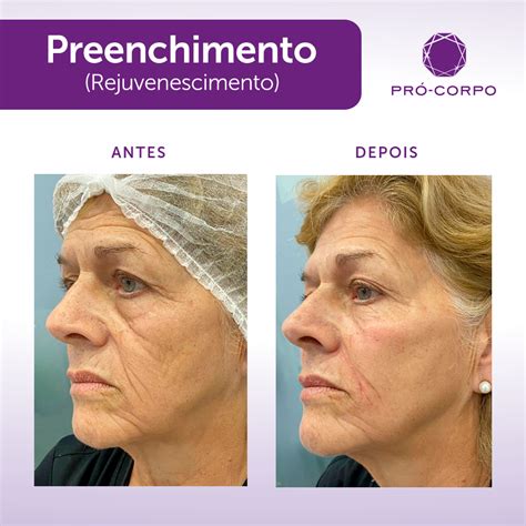 Preenchimento De Malar Antes E Depois - Preenchimento Malar: Técnica para Rejuvenescer e Harmonizar