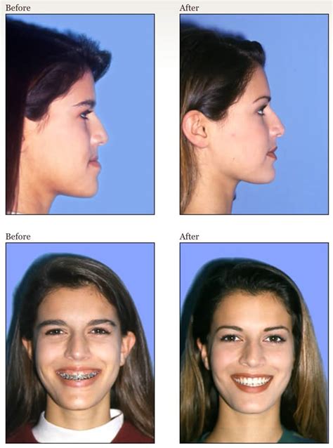 jawline stretch  safe  effective treatment   overbite