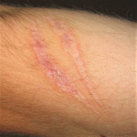 Scar Repair: Restore and Revitalize | Dr. Kally Papantoniou