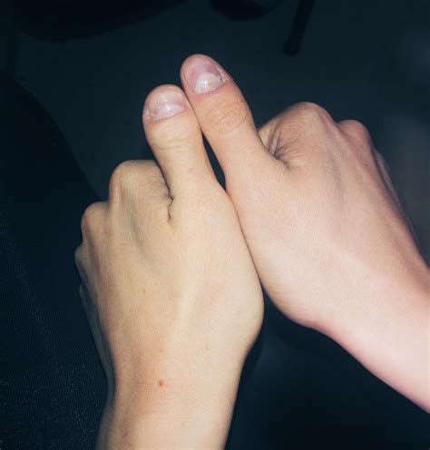 I have fraternal thumbs, 1 from each parent due to a genetic mutation