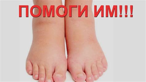 НОГИ ОТЕКАЮТ, СИЛЬНО УСТАЮТ, И ЧУВСТВУЕТСЯ В НИХ ТЯЖЕСТЬ? Тогда ...