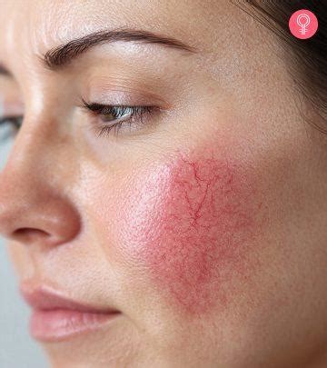 6 Quick Ways To Get Rid Of Broken Capillaries On The Face