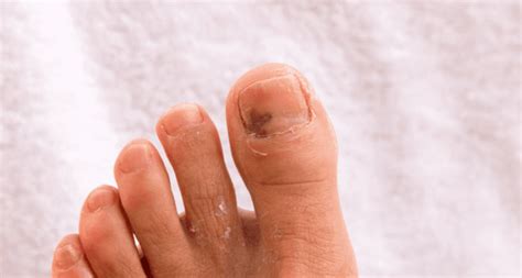 Discover Everything You Need to Know About Nail Fungus