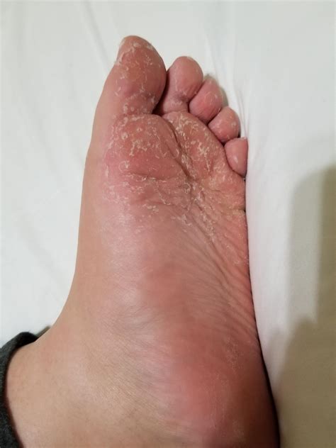 Why Are My Feet Peeling? Causes What To Do | atelier-yuwa.ciao.jp