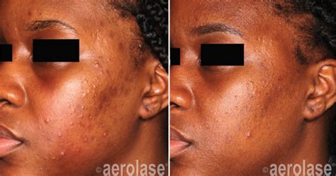 Aerolase Neo Elite® Laser Treatment in Colorado Springs - PureLee Redefined