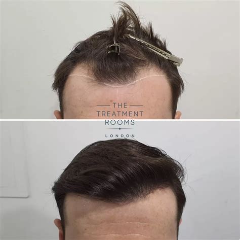 FUE Transplant Before & After | Treatment Rooms London