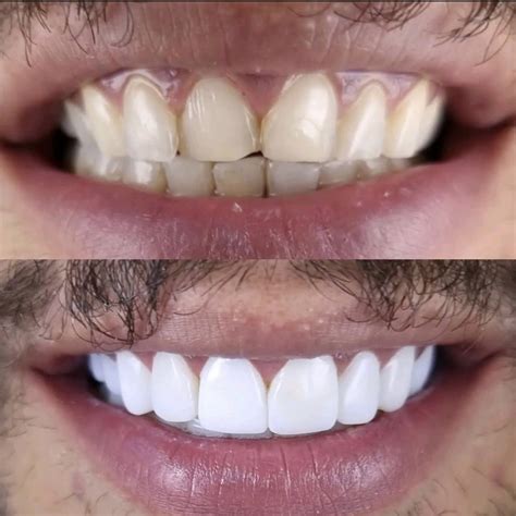 zirconia veneers  sherlyn weyer blog