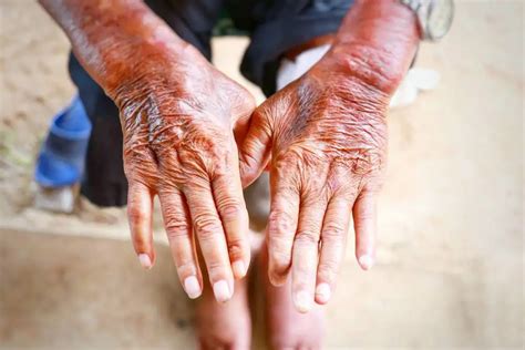 scleroderma systemic sclerosis medical channel asia