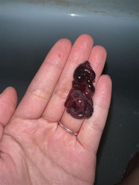 PERIOD , MISCARRIAGE OR BLOOD CLOTS ? : r/Periods