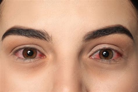 Eye Flu (Conjunctivitis) | Types, Symptoms, Causes & Home Remedies - Myhealthopedia