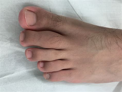 painful swollen toe  bmj