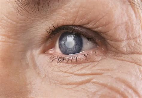 Understanding Cataracts | The Clouding of the Eye’s Lens