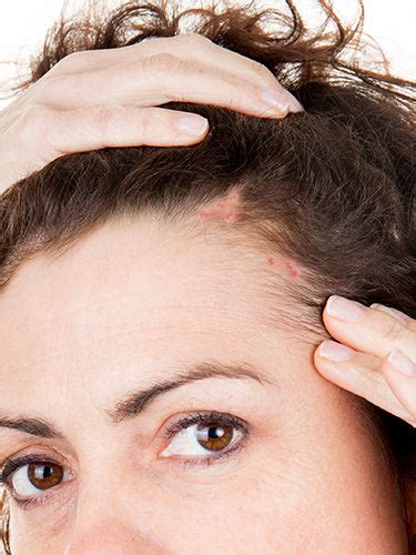 Reasons Behind Pimples On Scalp – Re'equil