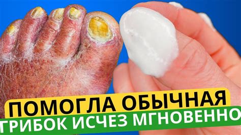 Эта ЯДРЁНАЯ Советская Мазь Разъест Весь Грибок с Ногтей! Есть в Любой ...