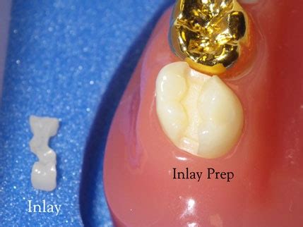Onlay vs. Inlay vs. Crown | Onlay, Inlay, Porcelain ceramics