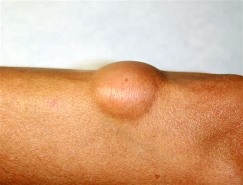 Zeckenbiss: Ursachen, Symptome & Behandlung