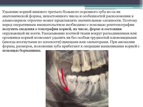 Методика сложного удаления зубов и их корней - презентация онлайн