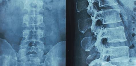 Spinal Cord Injury & Physical Therapy - Above & Beyond Physical Therapy