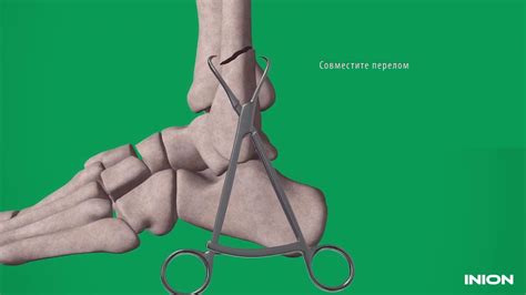 Перелом голени: хирургическая техника установки биодеградируемых ...