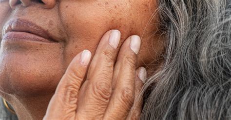 effective age spot treatments  bromley beutiva skin clinic