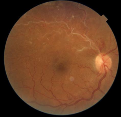 nathaniel harooni od  linkedin unilateral retinal hypoxia  nvd